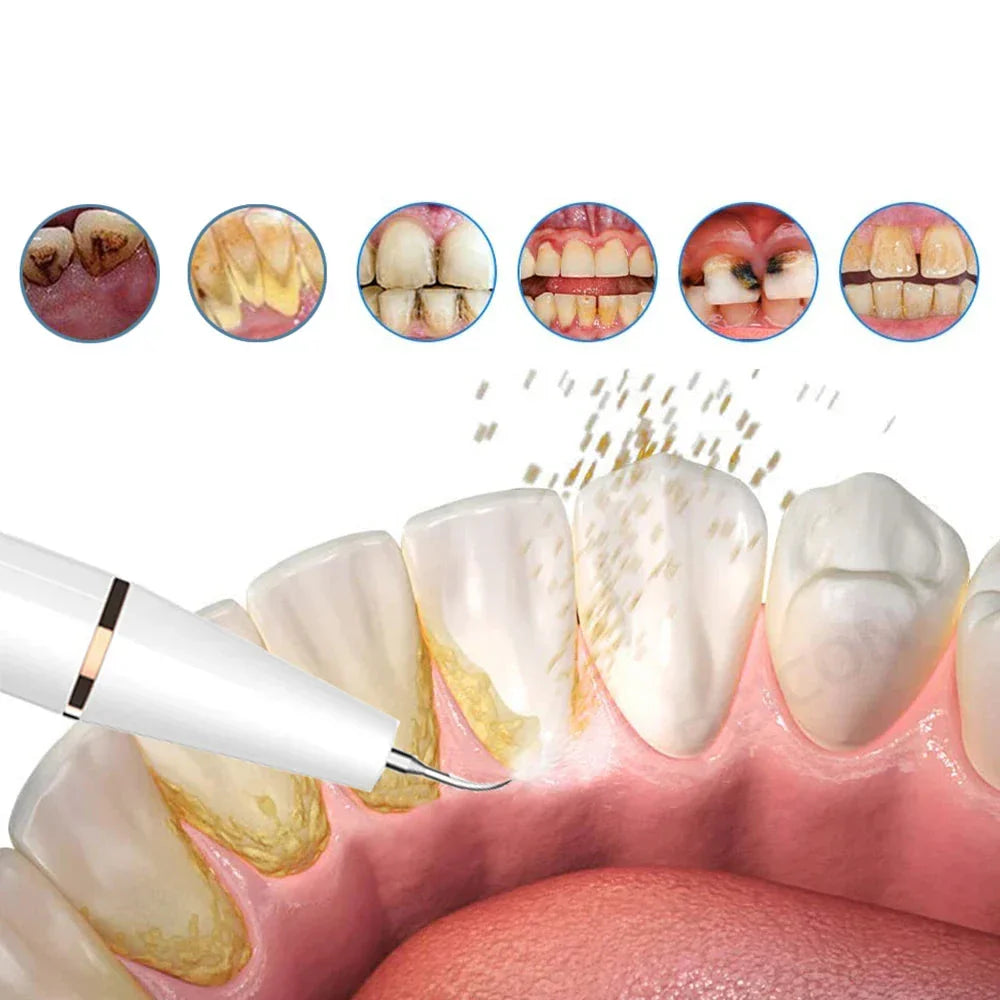 Ultrasonic Scaler | Stain-Removing Dental Tool for Home
